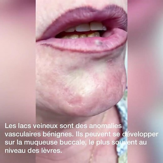 👩‍⚕️Traitement de lac veineux au laser Nd Yag long pulse