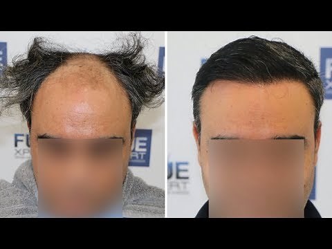 FUE Hair Transplant (3500 Grafts in NW V) Dr. Juan Couto - FUEXPERT CLINIC- Madrid, Spain
