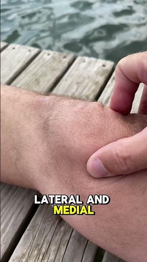 What is Patellar Mobilization After Knee Replacement Surgery?