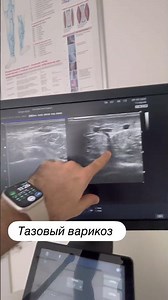 Varicose veins on the leg. Atypical form. Varicose vein treatment. Recommendations. Phlebologist ...