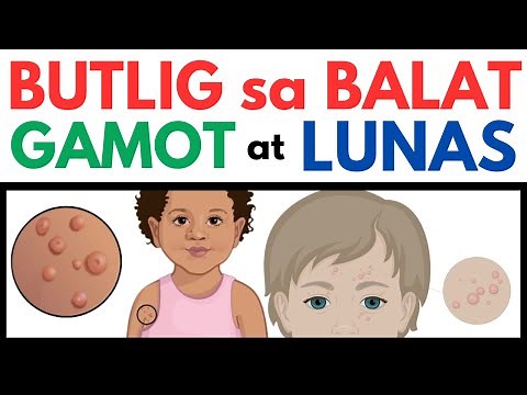 BUTLIG sa BALAT - Gamot at LUNAS | Home Remedies | Butlig sa Kamay, Mukha Katawan at iba pa