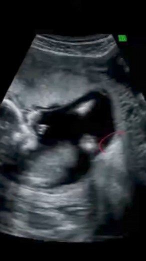 ST.MARINA OB GYNE & ULTRASOUND ❗❗ ✅Services offered:❗❗❗ ✨Prenatal checkup ✨Gyne consult ( myoma, PCOS, menstrual problems) ✨Papsmear ✅Ultrasound by OB-SONOLOGIST❗❗❗ ✨Transvaginal ✨ Pelvic (2nd and 3rd trimester) ✨Congenital anomaly scan ✨ Biophysical Scoring ✨ Doppler (gyne, placental, fetal-maternal) ✅Other services (vaccination, etc)❗❗❗ # st.marinamd #gynecologist #ultrasound #OBSonologist #obgyn Message us now! 📱:0960-019-8133 Facebook,viber,messenger We are located at 29 f.torres st.Concepc