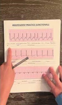 How to Identify a Premature Junctional Contraction (PJC)