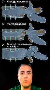 Vertebral compression #wedge #fractures