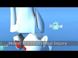 Lauge Hansen SA Supination ADduction (Inversion) Ankle Fracture