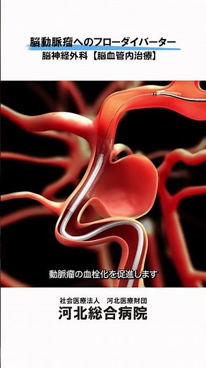 【脳動脈瘤への脳血管内治療】脳動脈瘤へのフローダイバーター #河北総合病院 #杉並区 #脳神経外科 #脳動脈瘤 #血管内治療