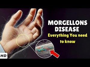 Morgellons Disease – Causes, Signs and Symptoms, Diagnosis & Treatment