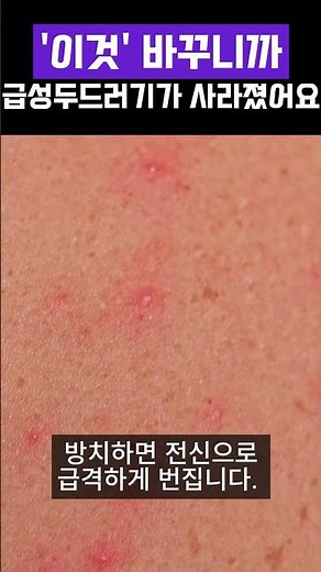 급성두드러기 만성으로 되기 전에 이 방법으로 쉽게 해결하세요 #급성두드러기 #두드러기 #피부가려움증 #두드러기증상 #바디워시추천