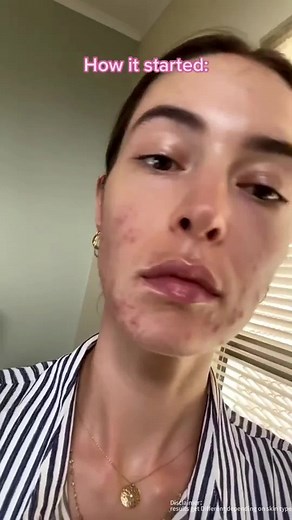 #skinever #skineverph #sleepmask #skinevermask #AcneTreatment #skincareroutine Apply ice cold on the face.