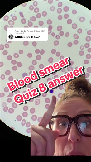 Replying to @Dr. Reese Jitters MD In a peripheral blood smear, a nucleated red blood cell (NRBC) appears distinct due to its nucleus, which is not present in mature red blood cells (RBCs). The key histological features include: \t1.\tNucleus: The nucleus of an NRBC is typically round or slightly oval and can be centrally or eccentrically located. It stains darkly with hematoxylin (basophilic), appearing dark purple to black. \t2.\tCytoplasm: The cytoplasm of NRBCs is more basophilic (blue) compa