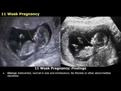 Obstetric Ultrasound Reporting | How To Write USG Reports | Pregnancy Sonography | TIFFA Scan