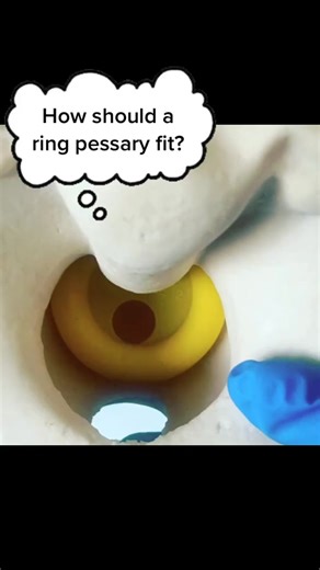 Understanding Pelvic Organ Prolapse: Pessary Ring and Pelvic Health