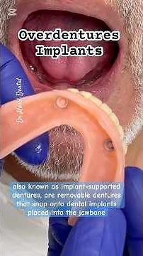 Overdentures, also known as implant-supported dentures is that Expensive?