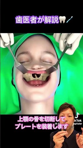 Osteotomy 💀 #orthodontics #surgicalorthodontics #maxillary osteotomy #cosmetic surgery #aesthetic...