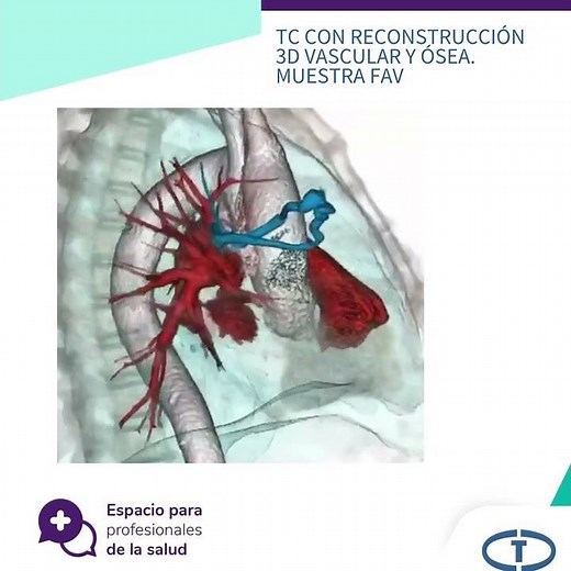 Fístula arteriovenosa Pulmonar: Estudio con TCMC y Reconstrucción 3D (Caso clínico)