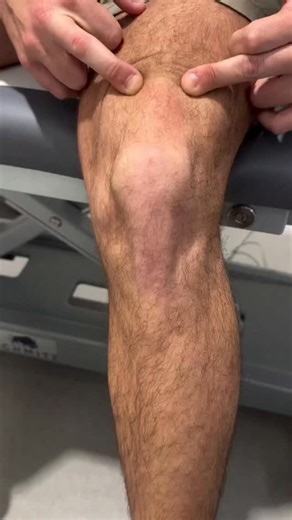 Rehabwithajay on Instagram: "Inverted J Sign The inverted J sign refers to the abnormal tracking pattern of the patella during active knee extension, where it shifts laterally before suddenly moving medially into the trochlear groove near terminal extension. This creates a reverse "J"-shaped path, visible when observing the patella from the front during quadriceps activation. This sign is often seen in individuals with patellofemoral joint instability, particularly those with recurrent patellar
