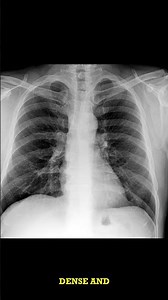 Chest RTG Case: Chronic Bronchitis Deconstructed