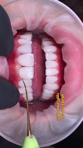 ‏#دكتور#محمدبندي##اسنان فنيرز #هوليوود سمايل #زراعة تجميل