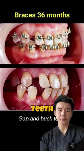 【Tokyo Dentist】How Traditional Metal Braces Work: Step-by-Step Guide #dentist #japan #asmr