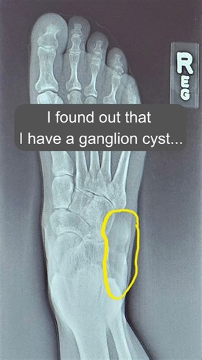 What does a ruptured ganglion cyst look like? #ganglion #ganglioncyst #cyst #cystpoping #foot #lumpy