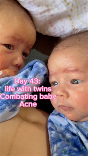 13K views · 141 reactions | Real talk: i had no idea what baby acne...