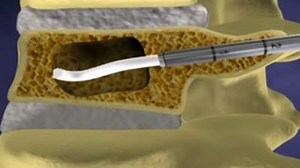 Nouvelle chirurgie du dos zoom sur la cyphoplastie | Kinésithérapie :un art et une science