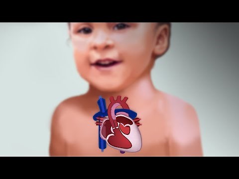 Surgical Palliation for Single Ventricle Lesions by M. Alvin, A. Schure | OPENPediatrics