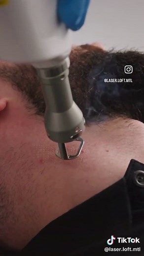 The Fractionated Erbium:YAG laser creates thousands of microscopic channels in the skin. This stimulates the production of new collagen, smoothing out wrinkles and resulting in firmer, more youthful skin. The depth of the laser energy can be adjusted to treat your specific skin concern. This laser is used to treat fine lines, dilated pores, acne scars, surgical scars and more! 🔖 Only 799$ for 3 sessions of full face #fractionallaser #fractionné #fractional #skin #resurfacingtreatment #skinresur