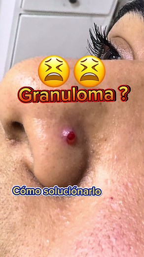 Cómo tratar un granuloma en tu piercing
