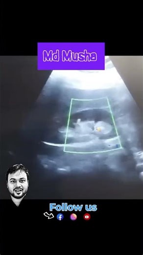 Nephrolithiasis color Doppler twinkling sing or artefacts 🍁🍁 #nephrolithiasis#calcus #calculi #usg