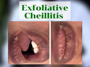 569 reactions · 13 shares | These are the types of cheilitis you didn’t know dear learn more what’s making you lips chapped and cracked here with Us by Dr Daniel MWANJE of Skin Dictionary. | Skin Dictionary | Facebook