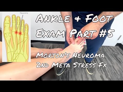 Ankle & Foot Exam Part #5 - Morton's Neuroma, 2nd Metatarsal Stress Fracture