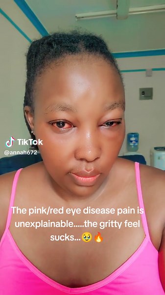 Avoid overcrowded places.....kimeniramba #redeyedisease #outbreak #highlycontagious