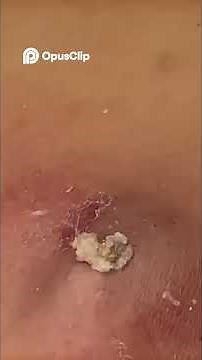 Incredible Blackhead Removal ASMR: Satisfying Clear Skin Therapy