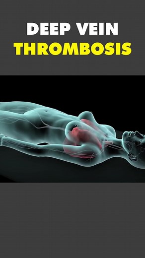 Understanding Deep Vein Thrombosis: 3D Animation Explained