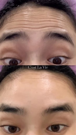 𝑪'𝒆𝒔𝒕 𝑳𝒂 𝑽𝒊𝒆 𝑺𝒑𝒂 & 𝑩𝒆𝒂𝒖𝒕𝒆́ on Instagram: "BOTULINUM TOXIN – XOÁ NHĂN TRÁN TỰ NHIÊN 💉✨ Nhăn trán không chỉ do tuổi tác 👉🏻 mà còn do cau mày, nhíu trán, stress mỗi ngày. Botox xoá nhăn trán giúp: ✔️ Làm mờ nếp nhăn động & nhăn tĩnh ✔️ Trán căng mịn, gương mặt tươi trẻ hơn ✔️ Không phẫu thuật – không nghỉ dưỡng ✔️ Hiệu quả nhanh, tự nhiên, không đơ mặt 💉 Kỹ thuật tiêm chuẩn giúp trán mịn nhưng vẫn giữ biểu cảm, không cứng – không “mặt tượng”. ⏳ Thời gian thực hiện: 10–15 phút 