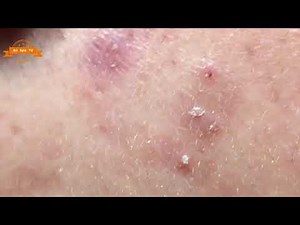 Best Satisfying Nose Plucking Blackheads Whiteheads Removal | Acne Treatment #07
