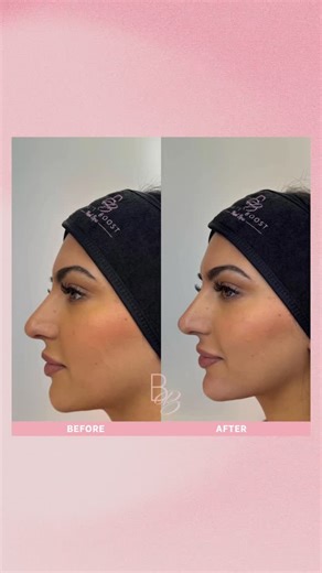 BEAUTY BOOST MED SPA ® | Aesthetic Procedures on Instagram: "Want the side profile of your dreams?✨ When done correctly, nose and chin filler can reshape how the entire face is perceived; especially in the profile, without surgery! 👏🏼✨ 👃🏼Nose Boost is used to smooth contour irregularities, improve symmetry, and create the illusion of a straighter profile. Because the nose contains critical blood vessels, this area requires an advanced, anatomy-driven approach. That’s why we use ultrasound pr