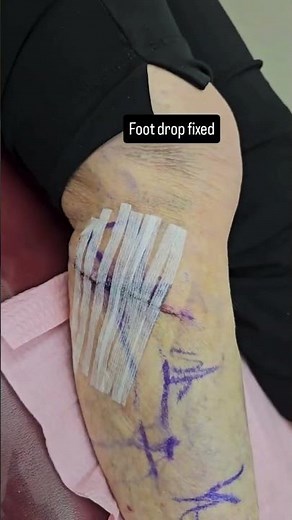 Foot Drop Recovery: Amazing Progress Just One Week After Peroneal Nerve Decompression Surgery!