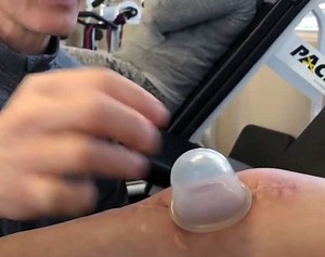 Cupping Therapy to Hide Knee Scars (2 Types)