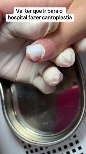 Cantoplastia: Tudo sobre a cirurgia nas unhas