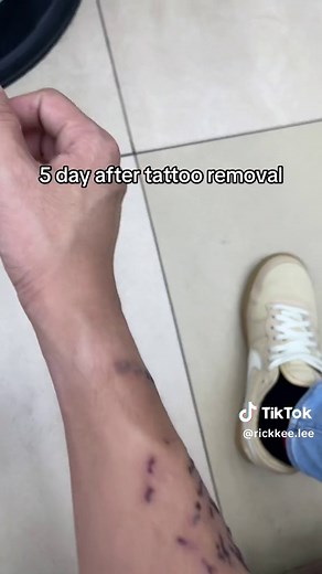 My daily process of removing the tattoo from my skin. Is frustrated when u do tattoo just need 8 hours but remove tattoo need month or even years to remove #tattooremoval #fyp #viral #tattoo #removal