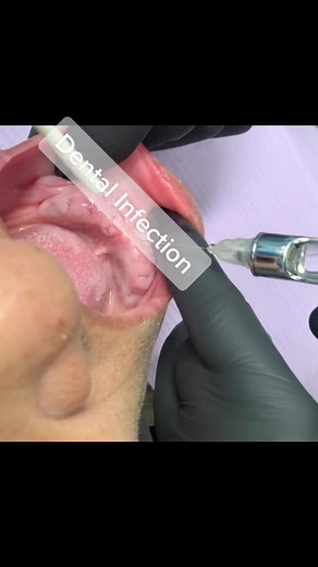 Watch closely👀 #dentist #dental #teeth #extractions #pullingteeth #enjoy #tooth #doctor #oralhealth #gumdisease #injections #dentisry