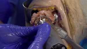 Identity™ Shoulder System Anatomic (TSA) to Reverse (RSA) Surgical Technique