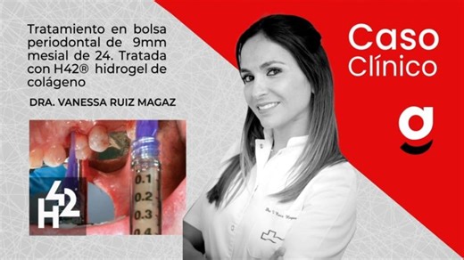 Tratamiento en bolsa perdiodontal de 9mm mesial de 24. | Dra. Vanessa Ruiz Magaz | Sanhigía, S.L.