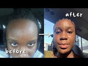How I Cleared my Fungal Acne in one month detailed*