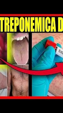 🩸Te enseño Como Hacer la PRUEBA RAPIDA TREPONEMICA para SIFILIS- Tutorias Laboratorio Clinico🔬