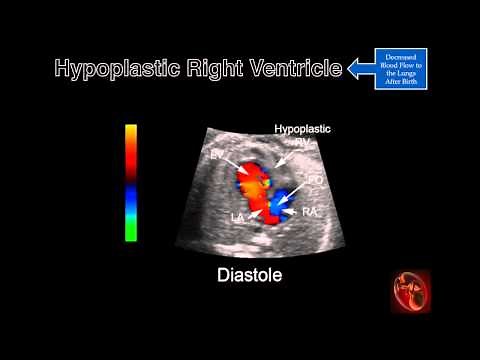 Fetal Echocardiography: Hypoplastic Right Ventricle