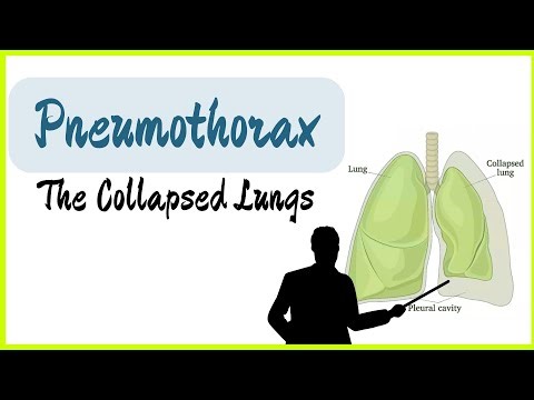 What is Pneumothorax