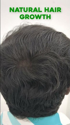 Amazing Hair Regrowth Journey with GFC Treatment 🚀🔥